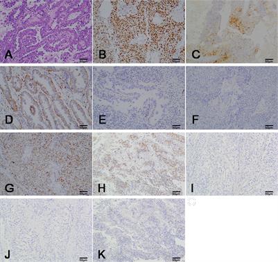 Clear Cell Carcinoma of the Endometrium: Evaluation of Prognostic Parameters in 27 Cases